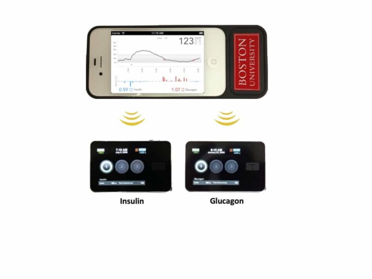 Artificial Pancreas