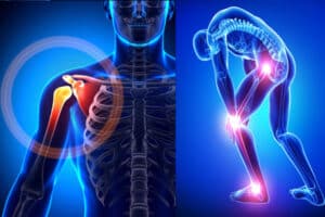 How to Treat Bone Fractures and Recover Quickly