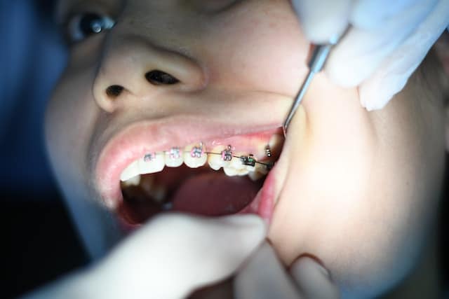 Dental Care with Braces for Diabetic Patients