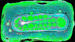 Innovative Pancreas Preservation Methods for Diabetes Patients